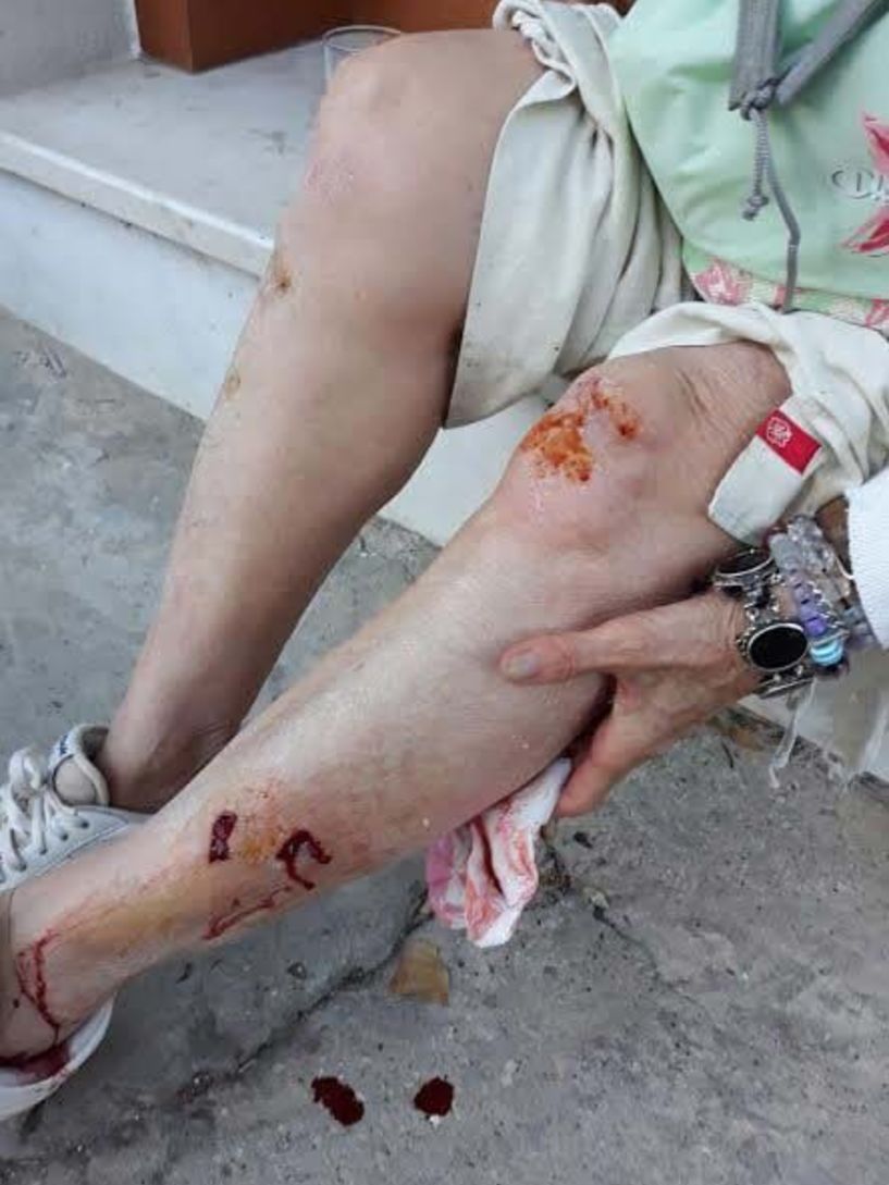 Νάουσα: Στο νοσοκομείο μετά από επίθεση αδέσποτων γυναίκα